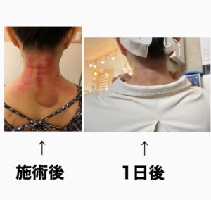 首のかっさ