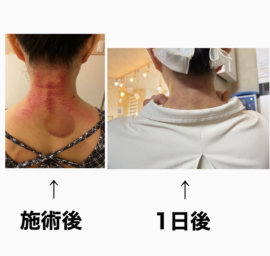 首のかっさ